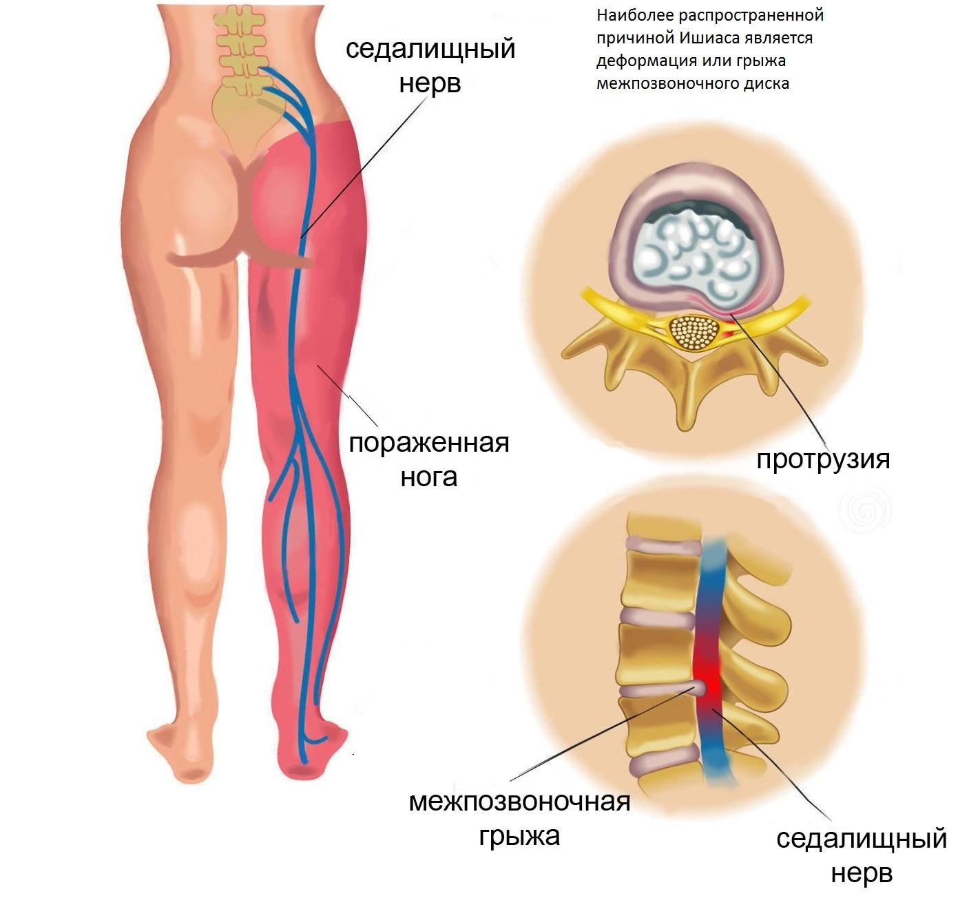 Анатомия седалищного нерва у человека